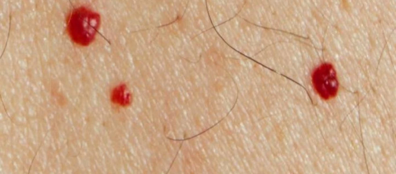 Όλα όσα πρέπει να γνωρίζετε για τις κόκκινες ελιές - Πότε να ανησυχήσετε